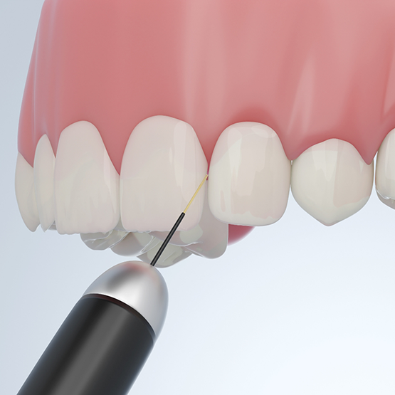 Illustration of soft tissue laser being used to treat gums