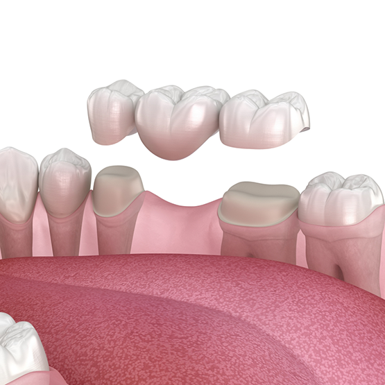 Illustration of dental bridge being attached to teeth in lower arch