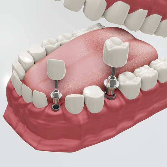 Illustration of dental implants and crowns being placed