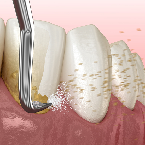 Illustration of scaling and root planing for lower arch