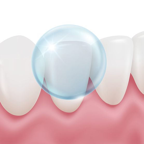Illustration of fluoride applied to tooth