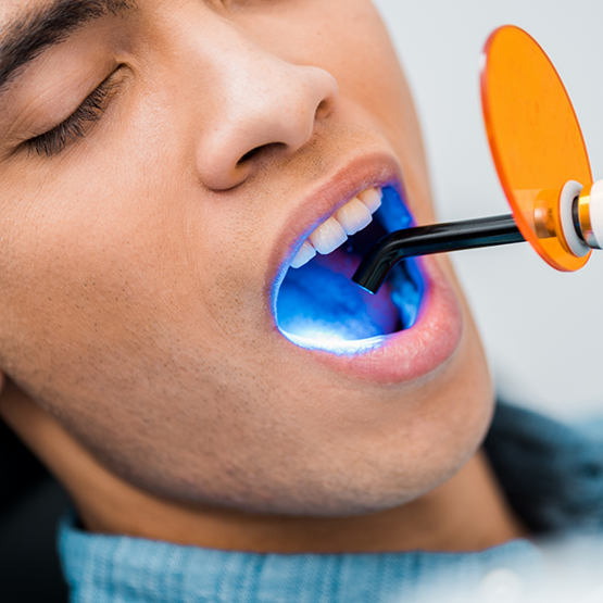 Holding open mouth for cosmetic bonding