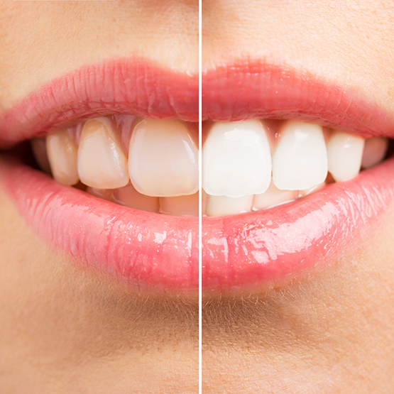 Smile before and after teeth whitening