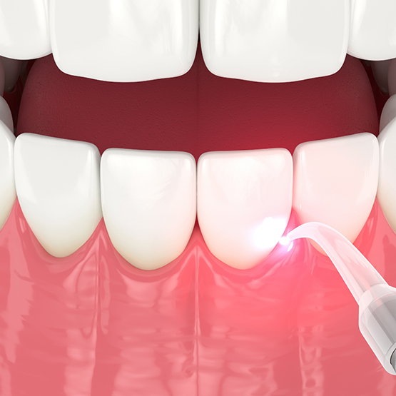 Illustration of dental laser being used for gum recontouring