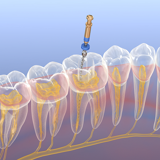 Illustration of tooth receiving root canal treatment in Fremont