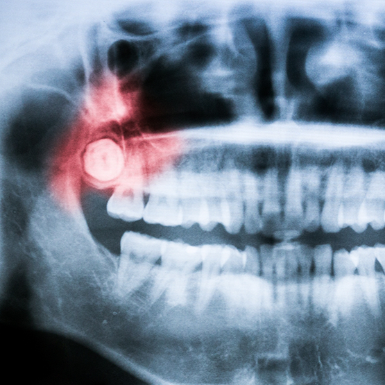 X-ray showing an impacted wisdom tooth