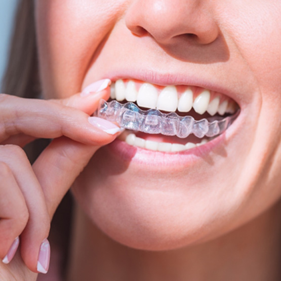 Person inserting a clear aligner into their mouth