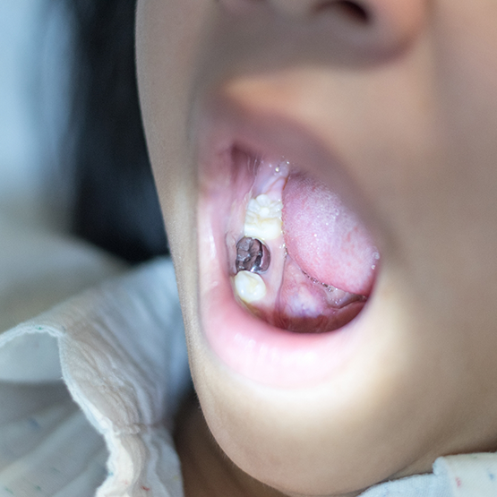 Opening mouth to show tooth with dental sealant