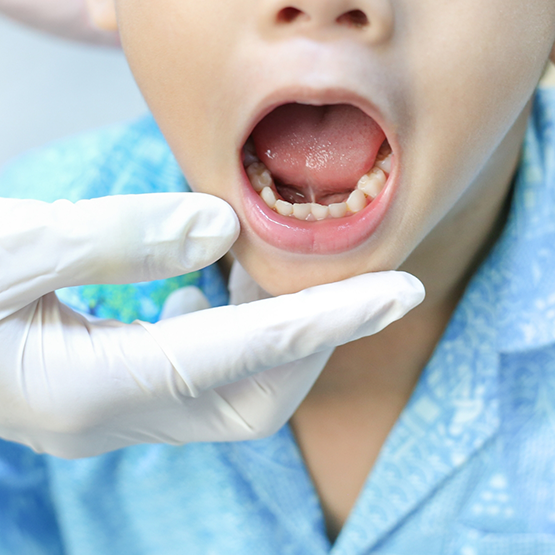 Child opening mouth to show lower teeth